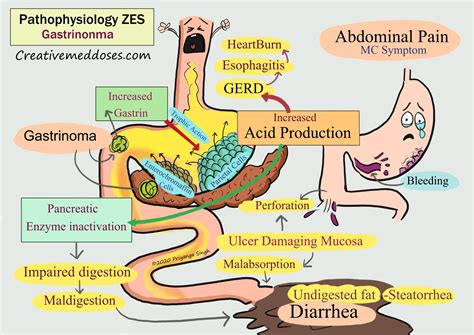 zollinger ellison syndrome pathophysiology creative med doses