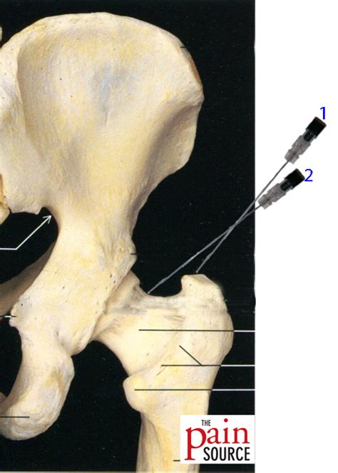 Procedure Intraarticular Hip Injection Under Fluoroscopy Lateral