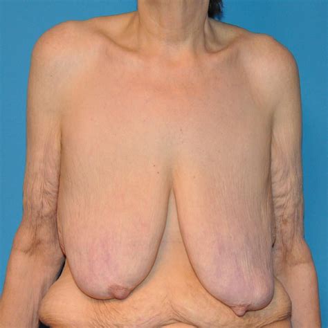 Super Saggy Tits Breast Reduction 2 Pics Xhamster