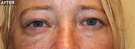 orbital northwest eyelid and orbital specialists ps and neos surgery