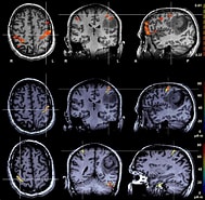 Bildergebnis für Epilepsie durch Hippokampussklerose. Größe: 189 x 185. Quelle: www.neuroradiologie.uk-erlangen.de