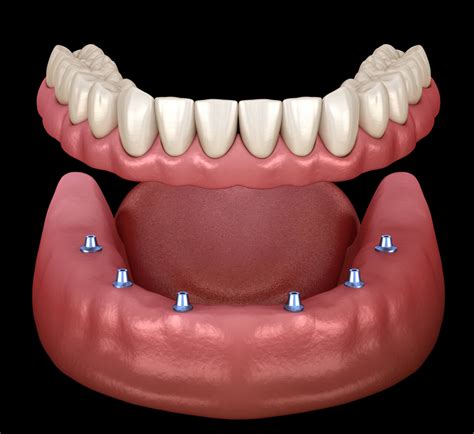 implant supported dentures      bellevuerxcom
