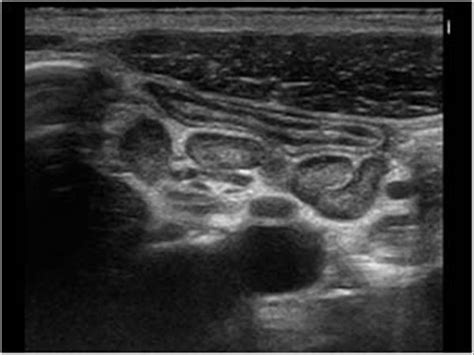 Abdomen And Retroperitoneum 1 6 Gastrointestinal Tract Case 1 6 3