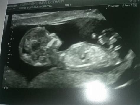 scan at 12 weeks and 4 days