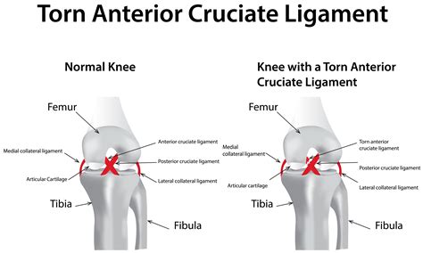 anterior cruciate ligament acl injury  symptoms diagnosis hot