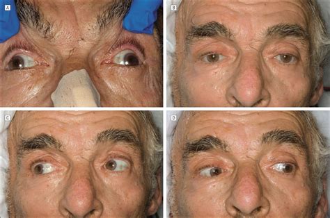 wall eyed bilateral internuclear ophthalmoplegia  ruptured aneurysm cerebrovascular