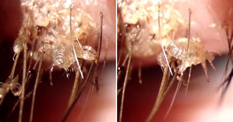 horrifying close  video  eyelash lice  give  nightmares