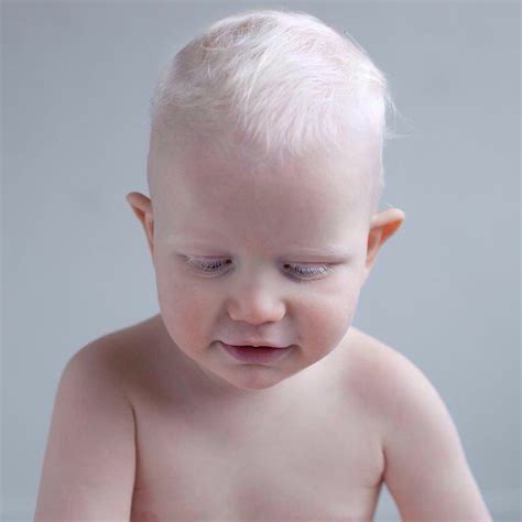 baby boy  albinism albino anders kijken  caitlin sas