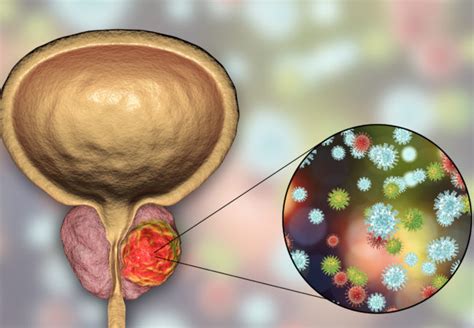 prostate cancer surgery vs radiation cancerwalls