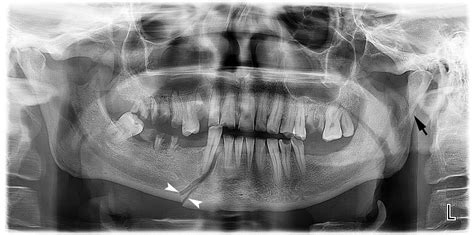 mandibular fracture  ray