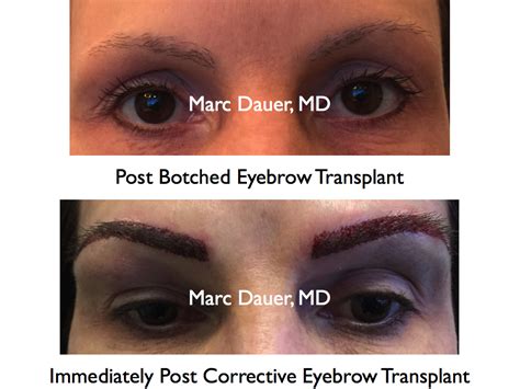 corrective eyebrow transplant hair transplant los angeles eyebrow