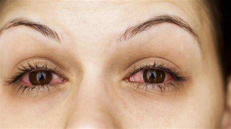 Is It Pink Eye Or Allergies Health