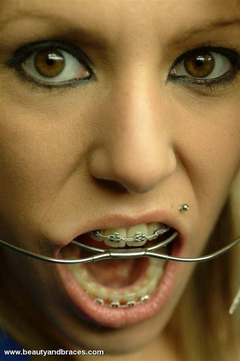 medical area dental braces orthodontics braces girls