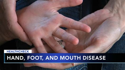 Doctors Seeing Spike In Hand Foot And Mouth Disease 6abc Philadelphia