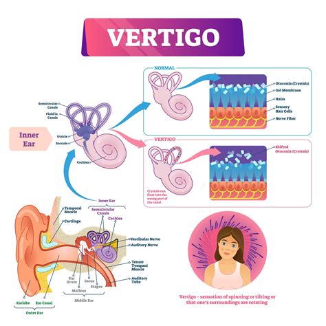 vertigo vector illustration labeled medical vestibular ear prob