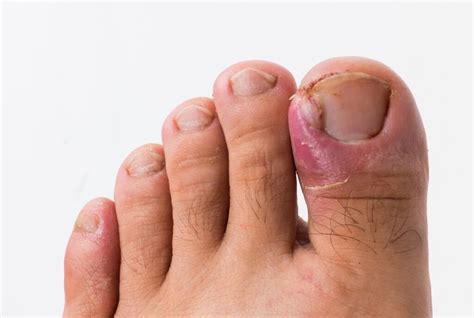 ingrown toenails  house podiatry