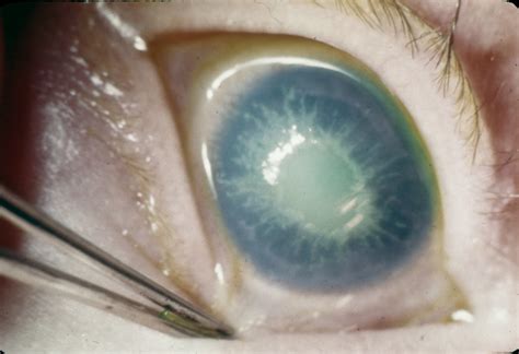 tyrosinemia type ii hereditary ocular diseases