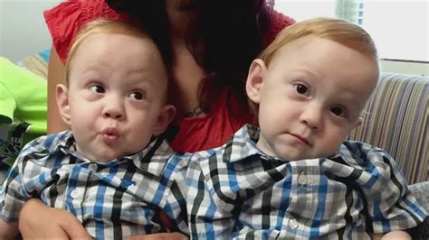 Formerly Conjoined Twins Reunited At Home For Mother S Day