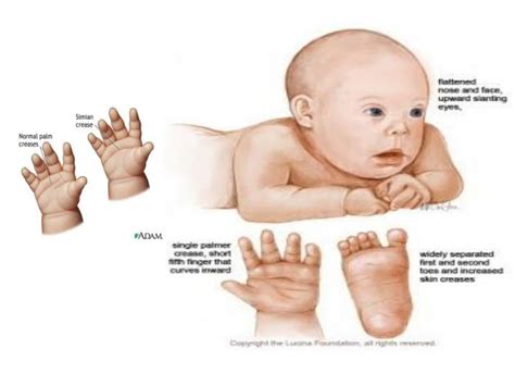 Ppt Chromosomal Abnormalities Powerpoint Presentation Id 5719987