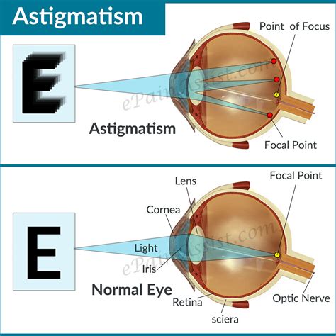 astigmatismcausestypessymptomstreatment lenses refractive surgery