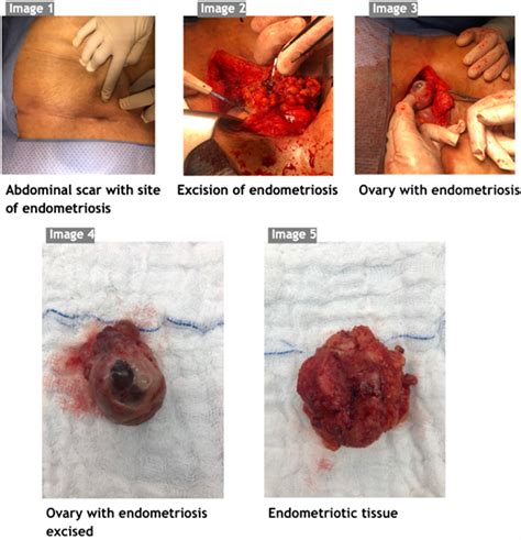 Post Hysterectomy Scar Endometriosis A Case Report