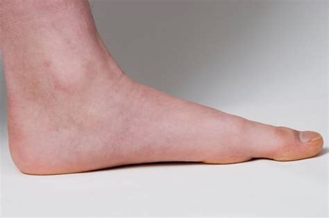 flat feet   adults children symptoms exercises treatment