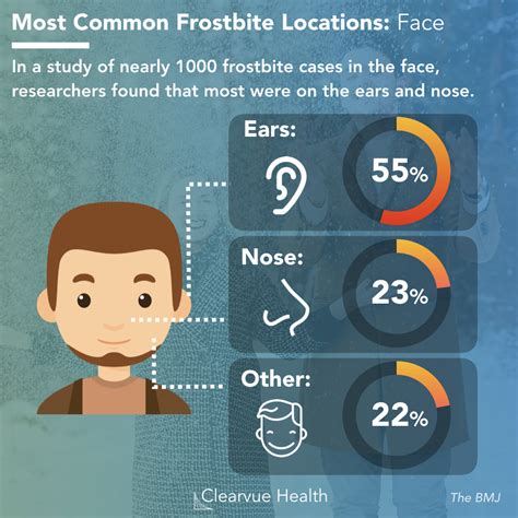 charts frost bite   face statistics prevention