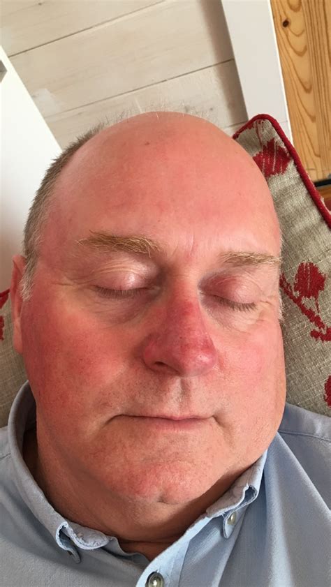 Taxi Driver Told His Skin Cancer On Just One Side Of His Face Was