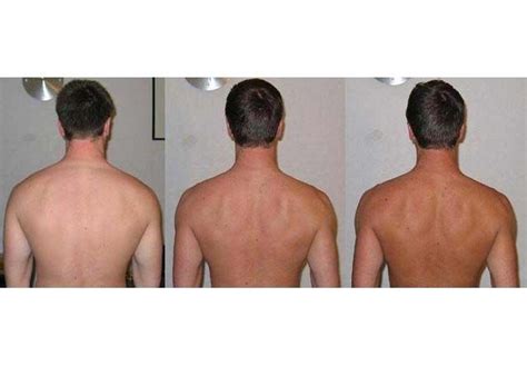 before and after melanotan tanning therapy sunless