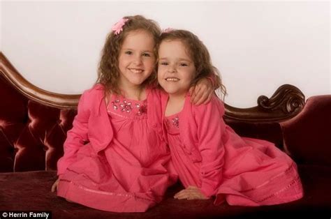 utah twins kendra and maliyah herrin who were born joined at the chest