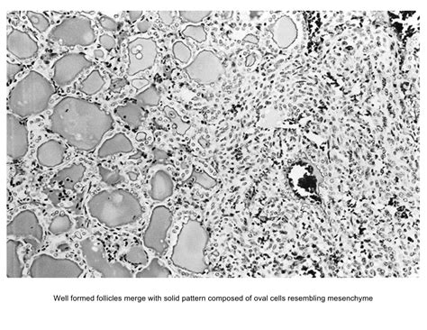 Pathology Outlines Follicular Adenoma