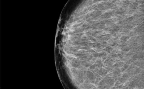 Mamografia Lbm