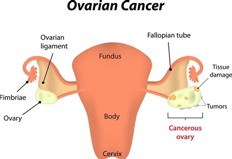 Ovary Pain Major Causes Anatomy Treatment Options