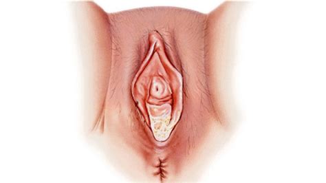 Vaginal Yeast Infection Causes Symptoms And Diagnosis