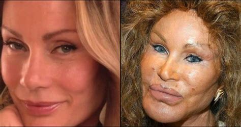 15 Once Beautiful Celebs Who Ruined Their Own Looks With Plastic