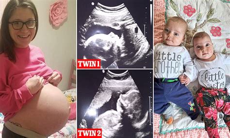 Woman Born With Two Wombs Due To Rare Condition Defies 1 In 50 Million