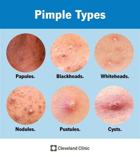 pimples causes vs acne types and treatment