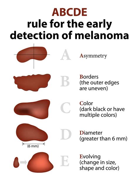 The Mole Guide What Does A Cancerous Mole Look Like Harley Medical