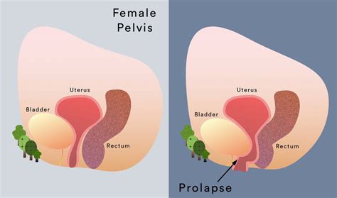 treatment for prolapsed uterus and bladder