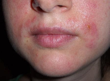 child rash treatment skin rash solution  girls