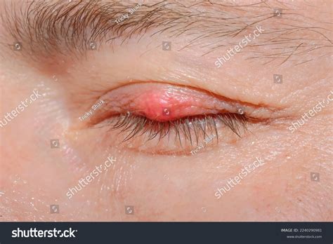 eyelash demodicosis mite diseas demodex chalazion foto stock