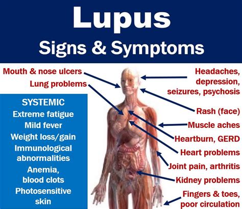 lupus signs  symptoms  full description  features