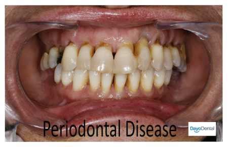 ultimate guide  periodontal disease periodontitis