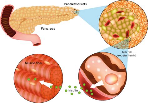 focus  beta cell mass   prevent type  diabetes research