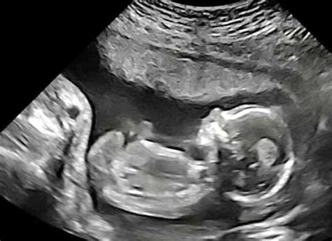 ultrasound clinic fails to identify unborn s fatal condition and got