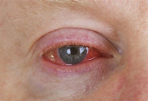 10 Of The Most Common Eye Problems In The World Page 3 Of 5