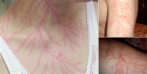 Incredible Photos Show What Can Happen To Your Body If You Re Struck By