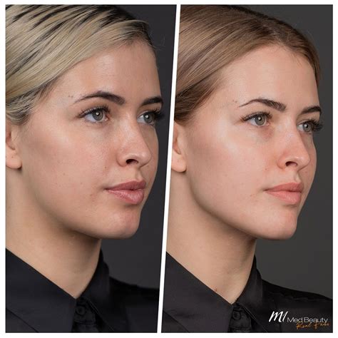 Cheek Enhancement With Dermal Fillers – M1 Med Beauty Australia