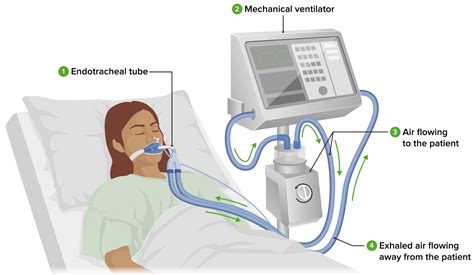 invasive mechanical ventilation concise medical knowledge