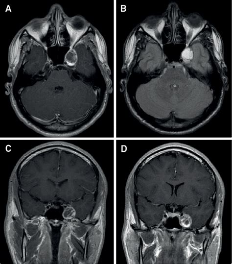 post contrast  mri showing  peripheral contrast enhancing ovoid